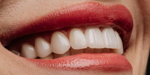 Est-ce que la cigarette electronique jaunit les dents ?
